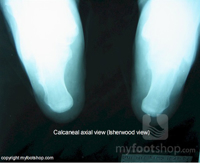 Calcaneal Stress Fracture | Differential diagnosis of heel pain